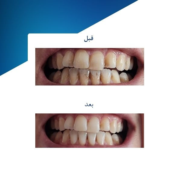 ژل سفید کننده دندان فاردنتو مدل TSR وزن 20 گرم مجموعه دو عددی