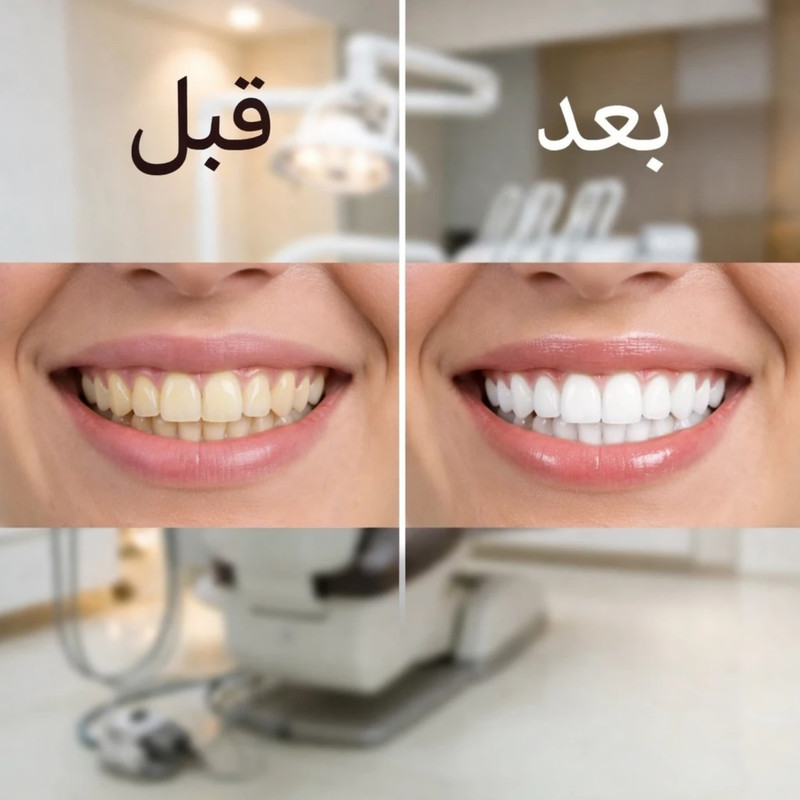 کیت بلیچینگ سفید کننده دندان مدل 05 وزن 77 گرم بسته پنج عددی