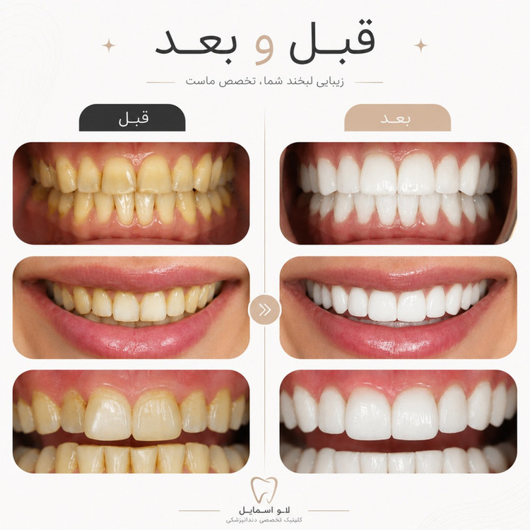 کیت بلیچینگ سفید کننده دندان مدل 05 وزن 77 گرم بسته پنج عددی