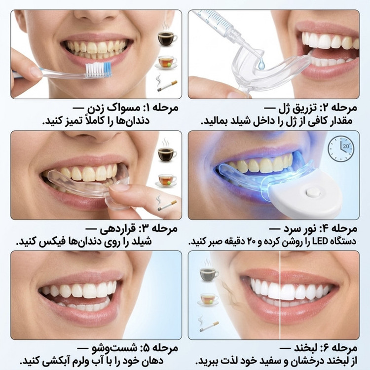 کیت بلیچینگ سفید کننده دندان مدل 05 وزن 77 گرم بسته پنج عددی
